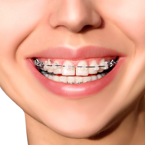 Dental Braces in Jaipur